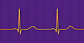 Long QT syndrome type 2 electrocardiogram, illustration