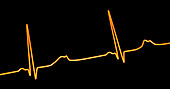 Long QT syndrome type 2 electrocardiogram, illustration