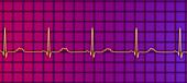Long QT syndrome type 2 electrocardiogram, illustration