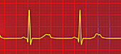 Long QT syndrome type 2 electrocardiogram, illustration