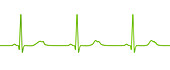 Long QT syndrome type 2 electrocardiogram, illustration