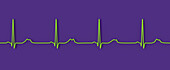 Long QT syndrome type 2 electrocardiogram, illustration