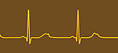 Long QT syndrome type 2 electrocardiogram, illustration