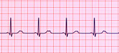 Long QT syndrome type 2 electrocardiogram, illustration