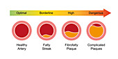 Atherosclerosis stages, illustration