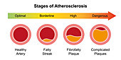 Atherosclerosis stages, illustration