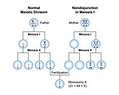 Nondisjunction monosomy x, illustration