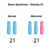 Trisomy 21 syndrome, illustration