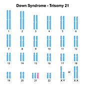 Trisomy 21 syndrome, illustration