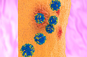 CAR-T cell therapy in rheumatoid arthritis, illustration