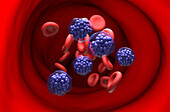 Diffuse large B-cell lymphoma, illustration