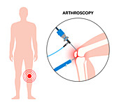 Knee joint arthroscopy, illustration