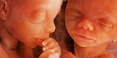 Twin foetuses