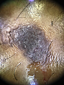 Seborrheic keratosis, dermoscopy