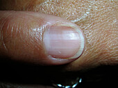 Discoloured nail