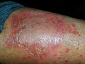 Pustular psoriasis