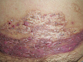 Pyoderma gangrenosum