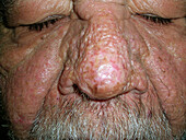 Rhinophyma after surgeries