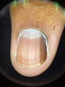 Discoloured nail, dermoscopy