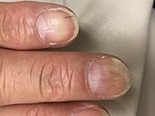 Psoriasis and ethnic melanonychia of the fingernail