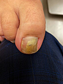 Fungal nail infection