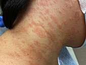 Pityriasis rosea rash