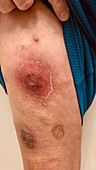 Pyoderma gangrenosum