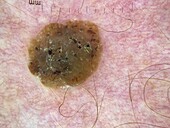 Seborrheic keratosis, dermoscopy