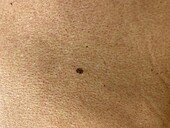 Seborrheic keratosis