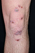 Impetigo lesions on a mans leg