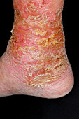 Varicose eczema on a man's ankle