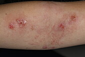 Infected atopic eczema on a girl's arm