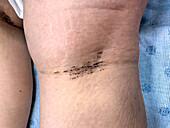 Terra-firma forme dermatosis