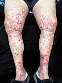 IgA vasculitis