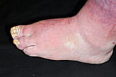 Congenital absence of toes in male patient