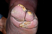 Congenital absence of toes in male patient