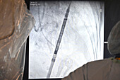 Live X-ray during TAVI procedure