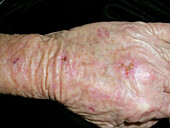 Treatment of actinic keratosis