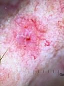 Treatment of actinic keratosis, dermoscopy