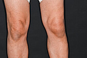 Swelling in a man's knee due to gout