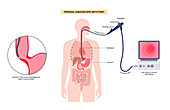 Peroral endoscopic myotomy, illustration