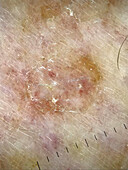 Disseminated superficial actinic porokeratosis, dermoscopy