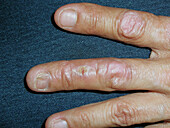 Linear lichen planus