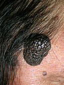 Seborrheic keratosis