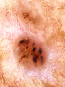 Basal cell carcinoma, dermoscopy