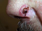 Basal cell carcinoma