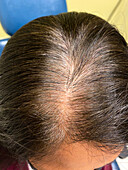 Female pattern hair loss