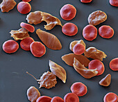 Sickle cell anaemia, SEM