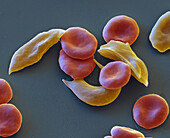 Sickle cell anaemia, SEM