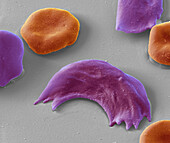 Sickle cell anaemia, SEM